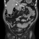 Diverticulitis, severe, colovesical fistula, fistula, vesicoureteral reflux: CT - Computed tomography